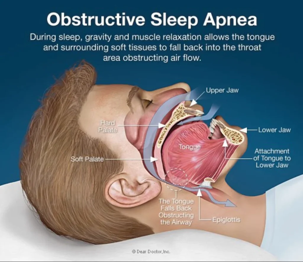 sleep apnea diagram