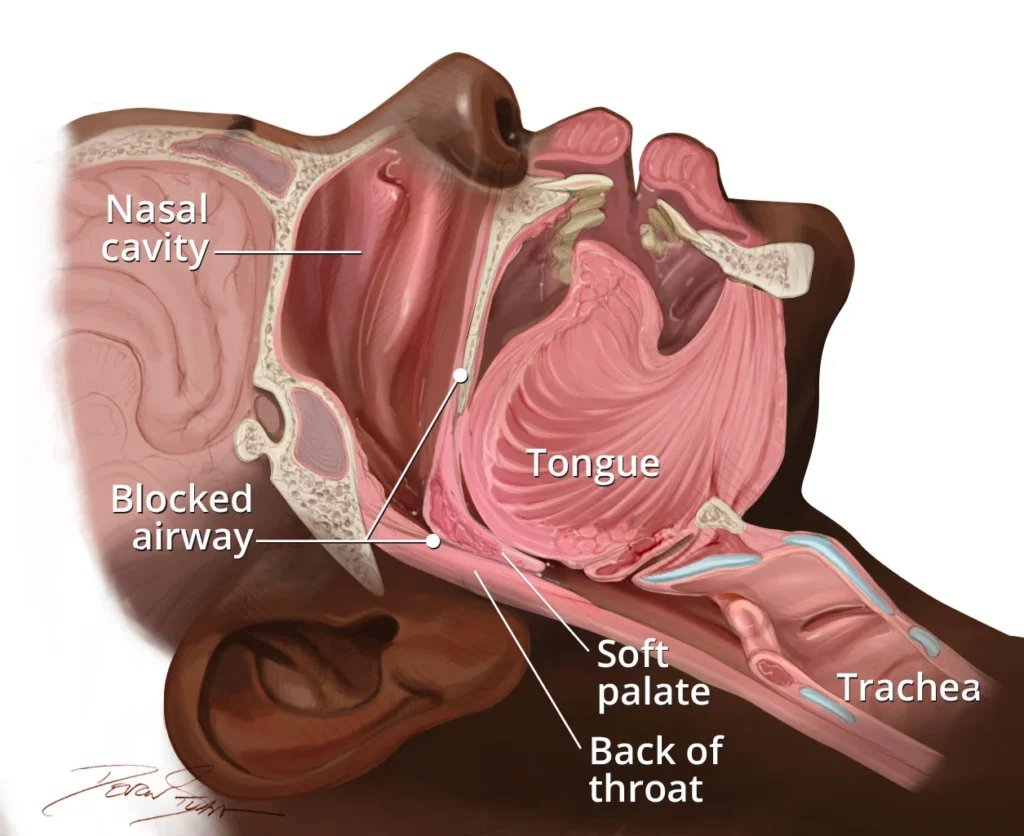 sleep apnea diagram